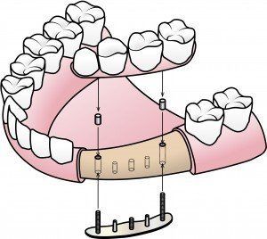 Dental crowns picture of implanting.