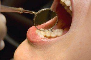 Dental mirror use for examining back side of teeth in oral pathology exam
