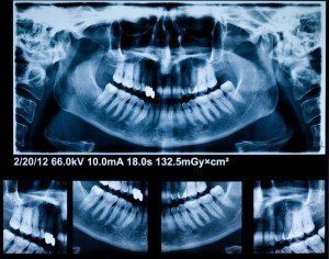 X-ray of patient's teeth and mouth for root canal treatment