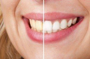 Before and after of a dental teeth whitening procedure.