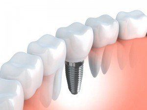 Tooth human dental implants (done in 3d graphics).
