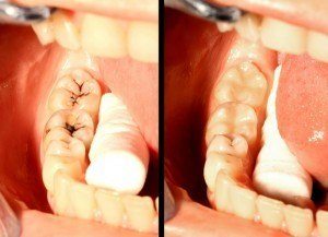 Patient before and after gum and teeth disease treatment.